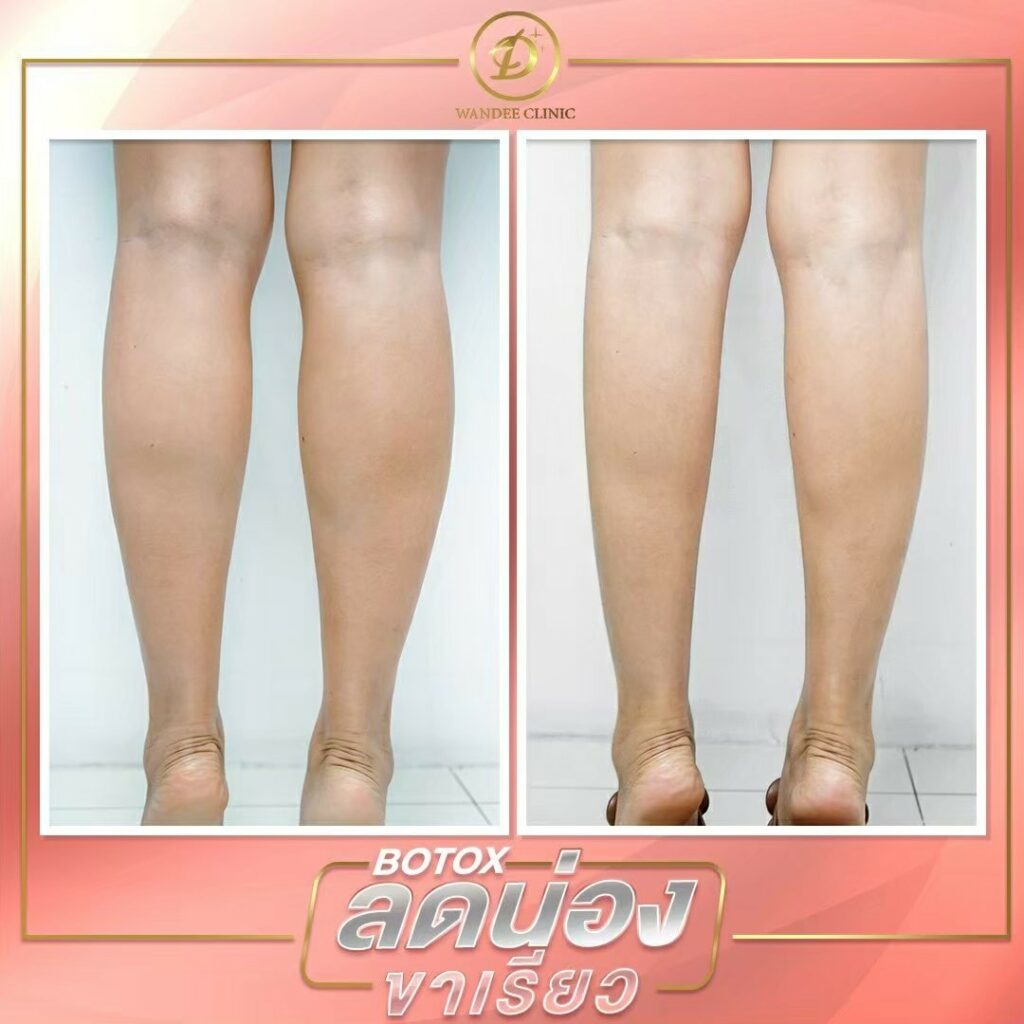 āļāļĩāļ botox āļāļĩāđāđāļŦāļāļāļĩ
