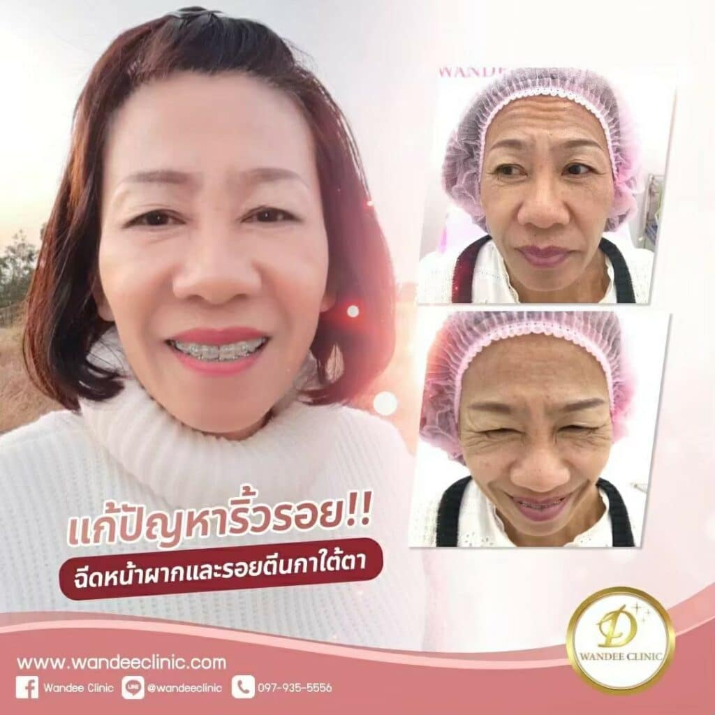 āļāļĩāļ botox āļāļĩāđāđāļŦāļāļāļĩ