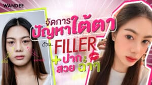 รีวิวฉีดฟิลเลอร์ใต้ตา