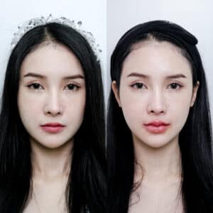 ฟิลเลอร์ปาก