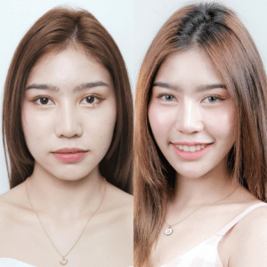 ฉีดโบท็อกซ์