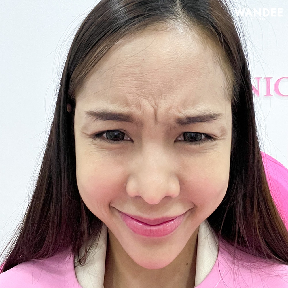 𝗕𝗢𝗧𝗢𝗫 ริ้วรอย แบบจุก ๆ