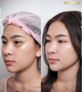 รีวิวฉีดฟิลเลอร์ใต้ตา