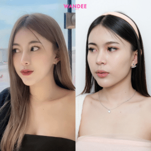 รีวิวฉีดฟิลเลอร์