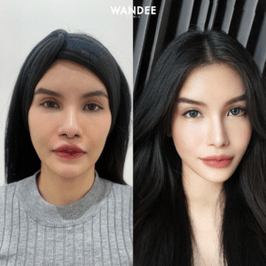 รีวิวฉีดฟิลเลอร์