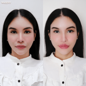 รีวิวฉีดฟิลเลอร์