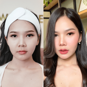 รีวิวฉีดฟิลเลอร์