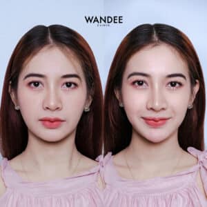 รีวิวฉีดฟิลเลอร์คาง