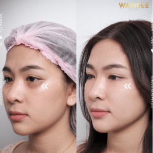 ฟิลเลอร์ใต้ตา