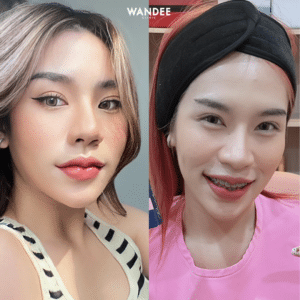 ฟิลเลอร์ปาก