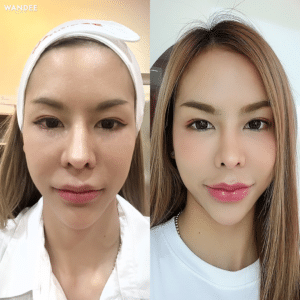 ฟิลเลอร์ปาก