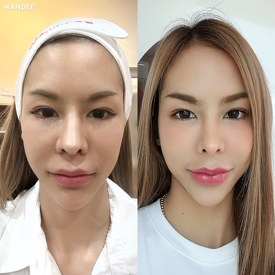 ฟิลเลอร์ปาก