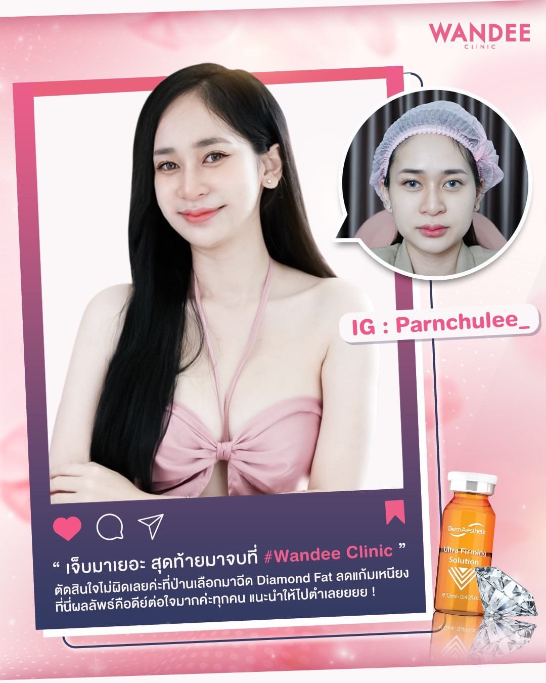 𝗠𝗲𝘀𝗼 𝗙𝗮𝘁 สลายไขมัน