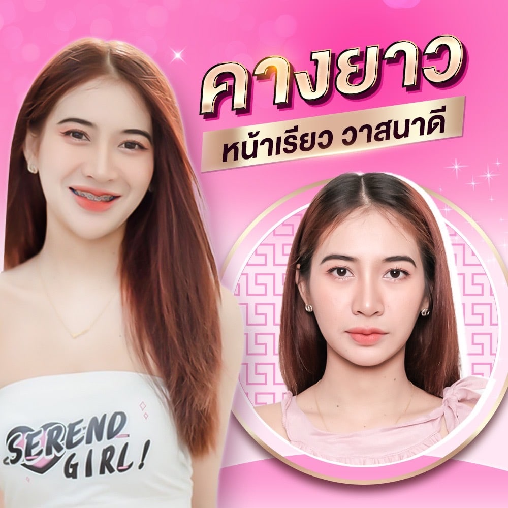 𝗙𝗶𝗹𝗹𝗲𝗿 เติมคางยาว