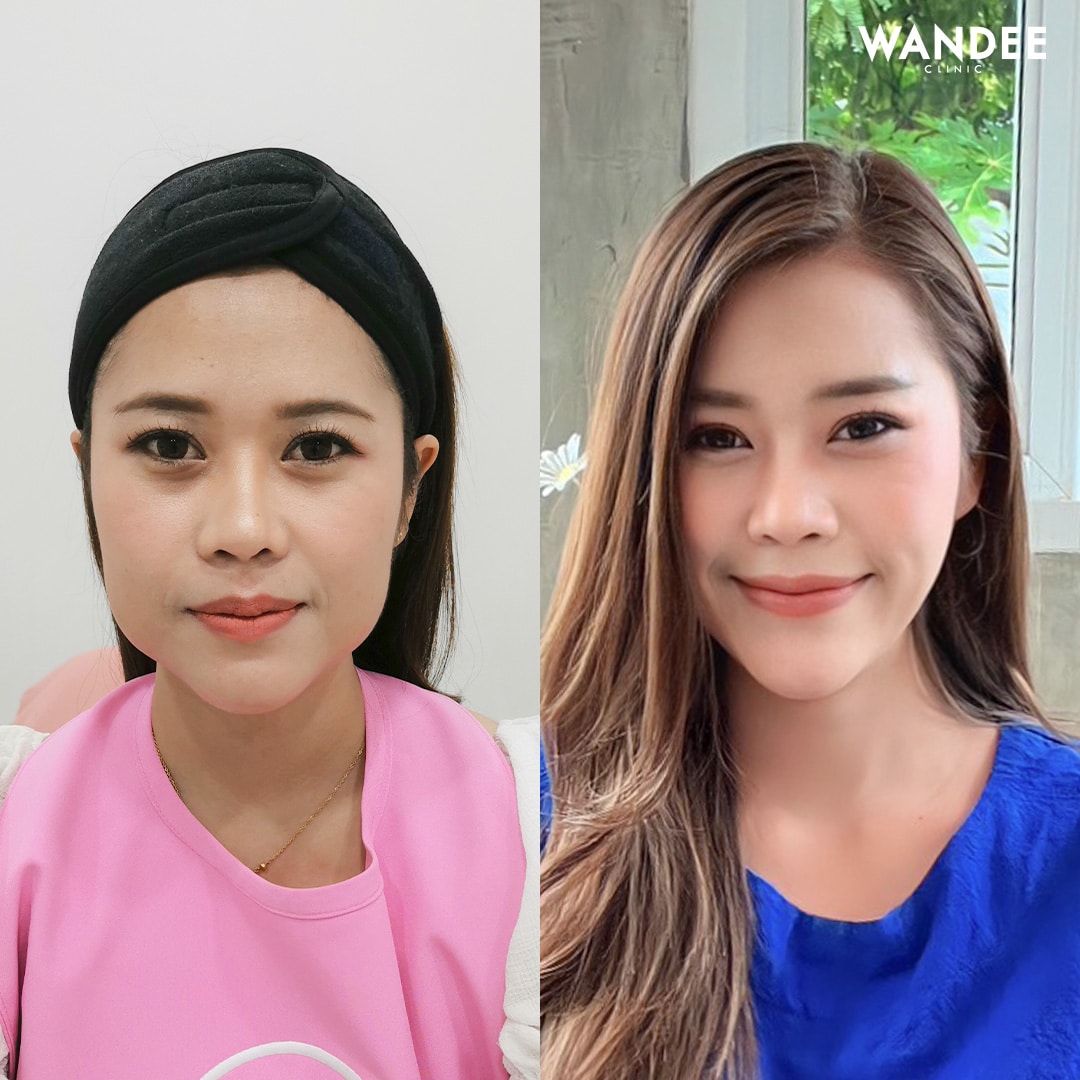 𝗕𝗢𝗧𝗢𝗫 ลดกราม