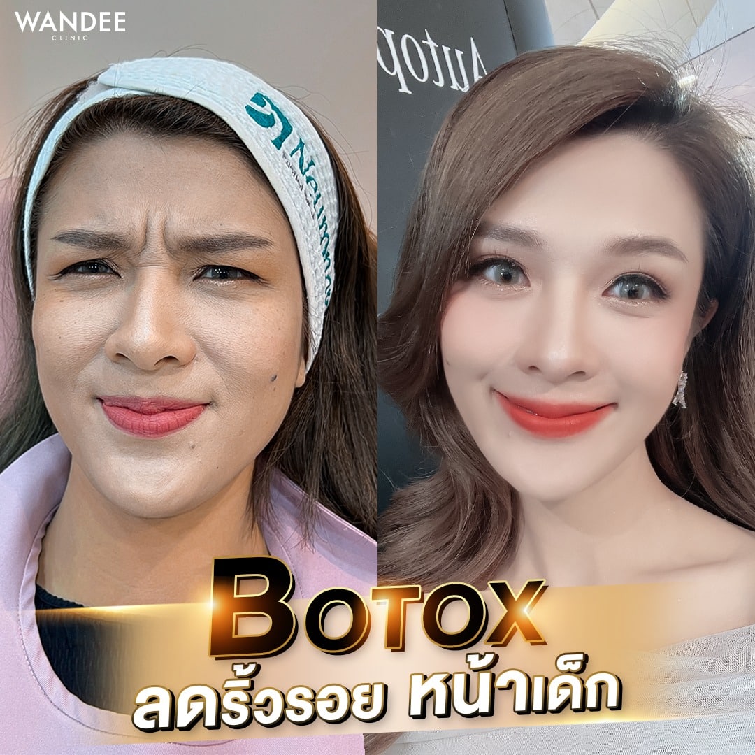 𝗕𝗢 ลดริ้วรอย