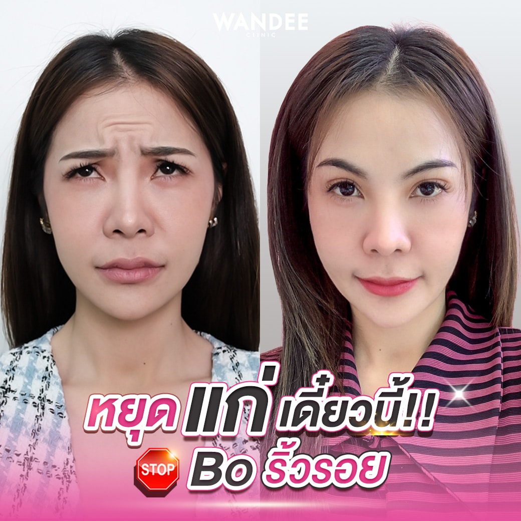 𝗕𝗢 ลดริ้วรอย