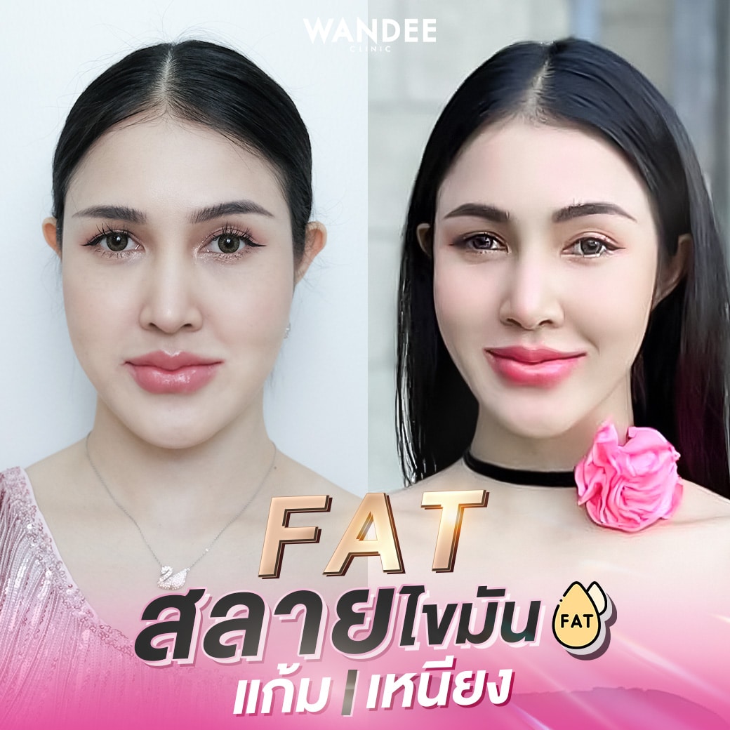 𝐅𝐀𝐓 เฟิร์มกระชับ ลดแก้ม