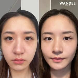 𝗙𝗜𝗟𝗟𝗘𝗥 ใต้ตา