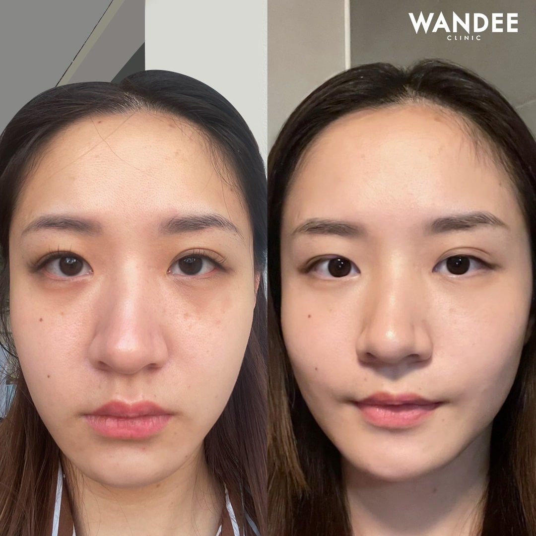 𝗙𝗜𝗟𝗟𝗘𝗥 ใต้ตา