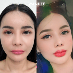 ฟิลเลอร์ปาก