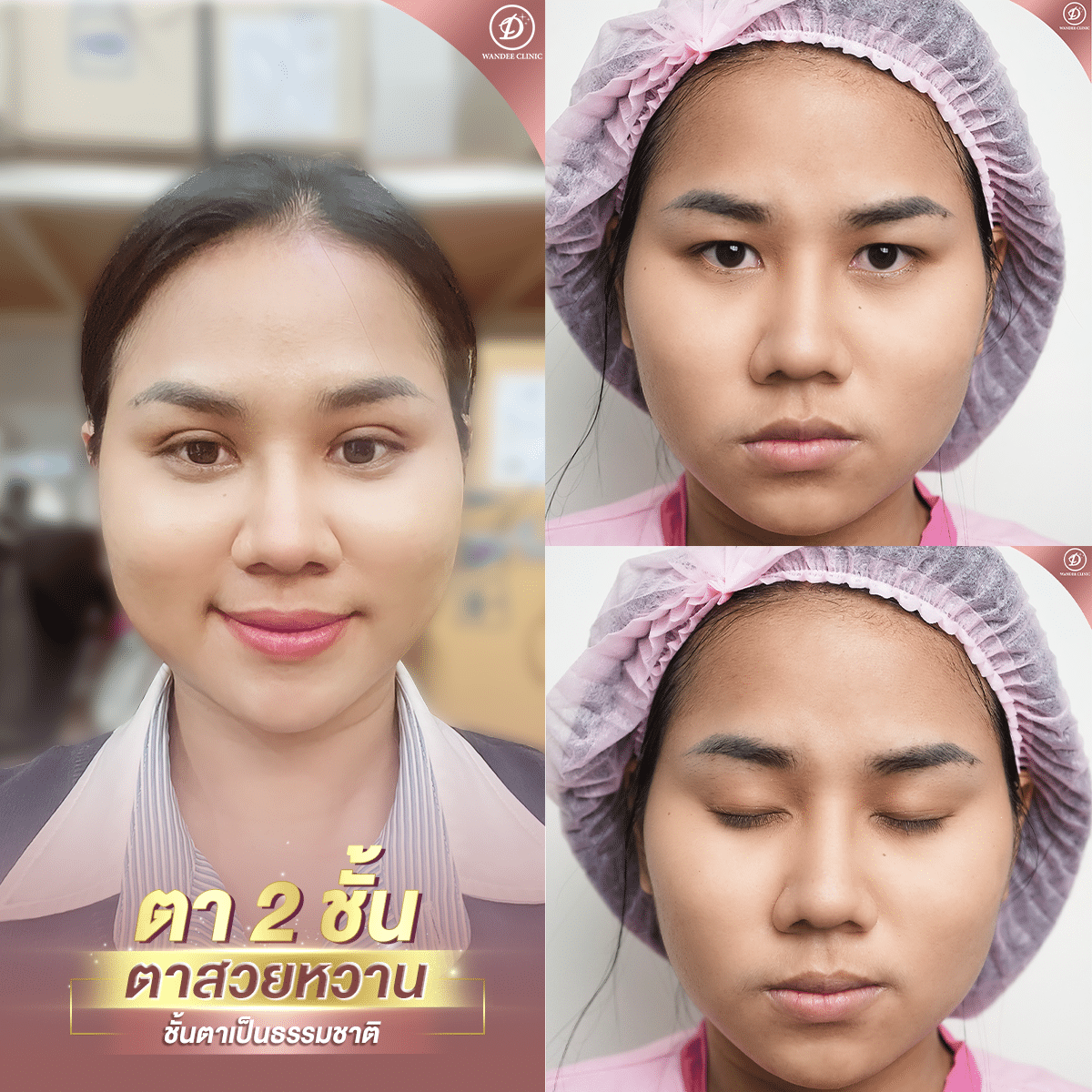 ศัลยกรรมตาสองชั้น