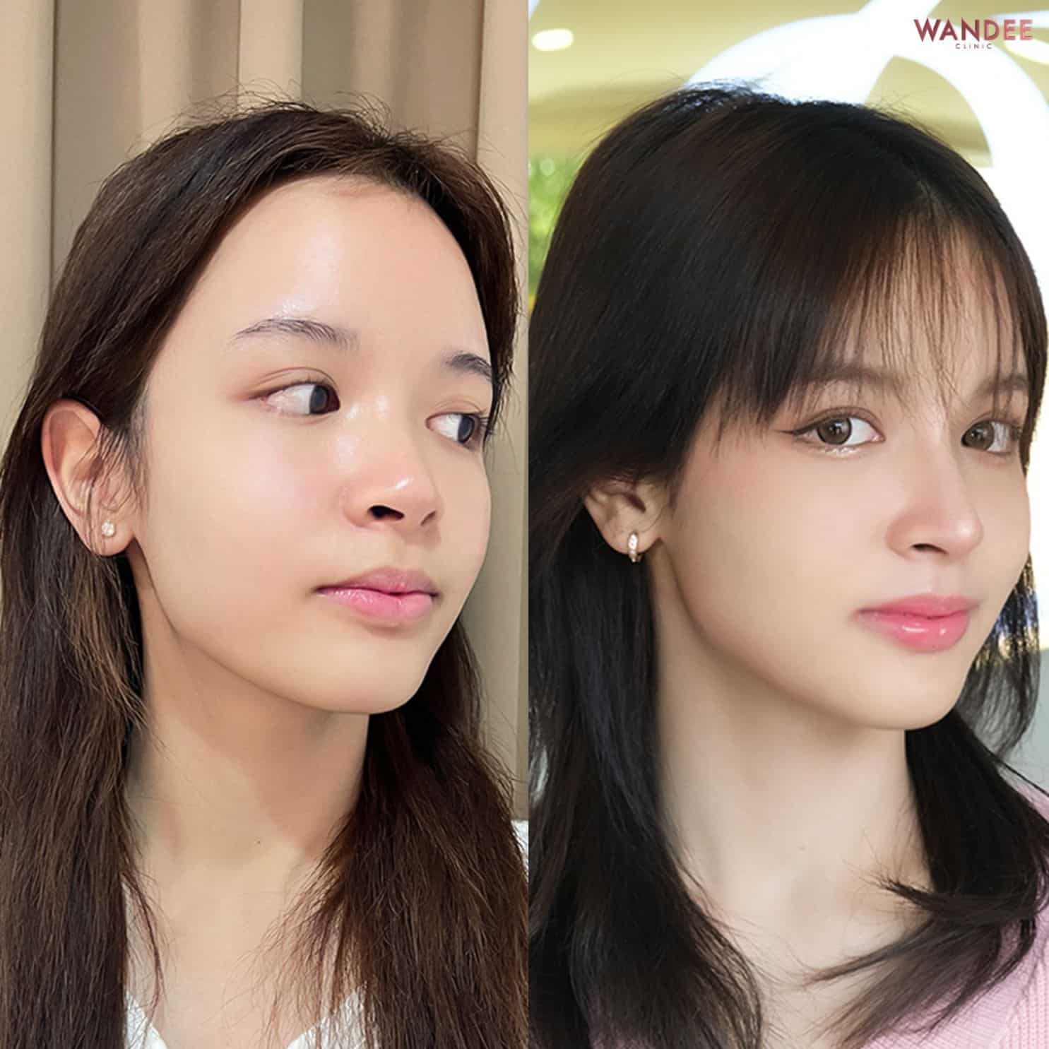 รีวิวเสริมจมูก