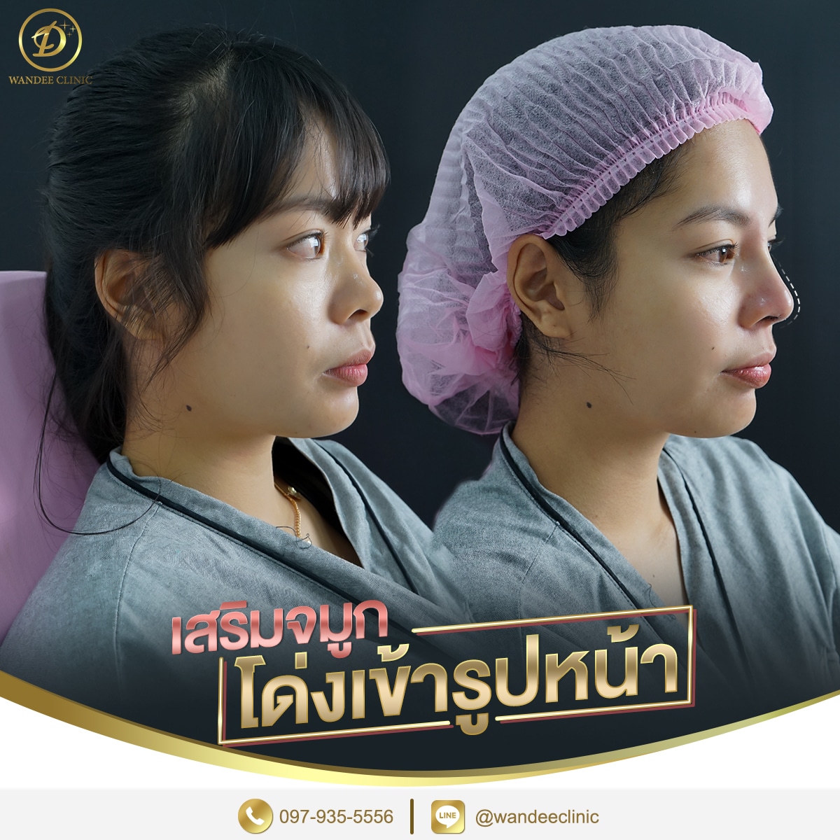 รีวิวเสริมจมูก