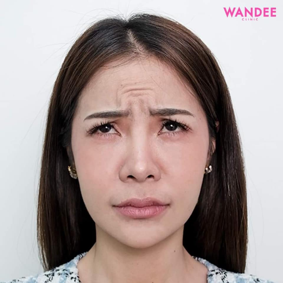 𝗕𝗢 ลดริ้วรอย