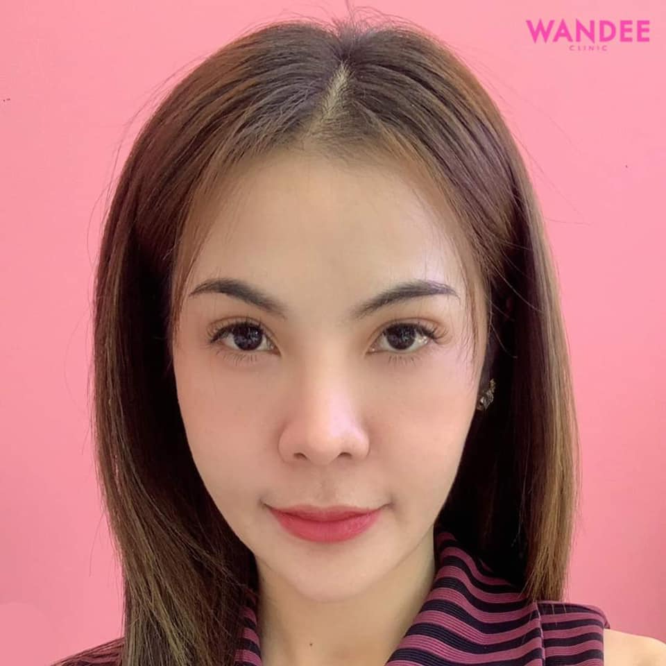 𝗕𝗢 ลดริ้วรอย