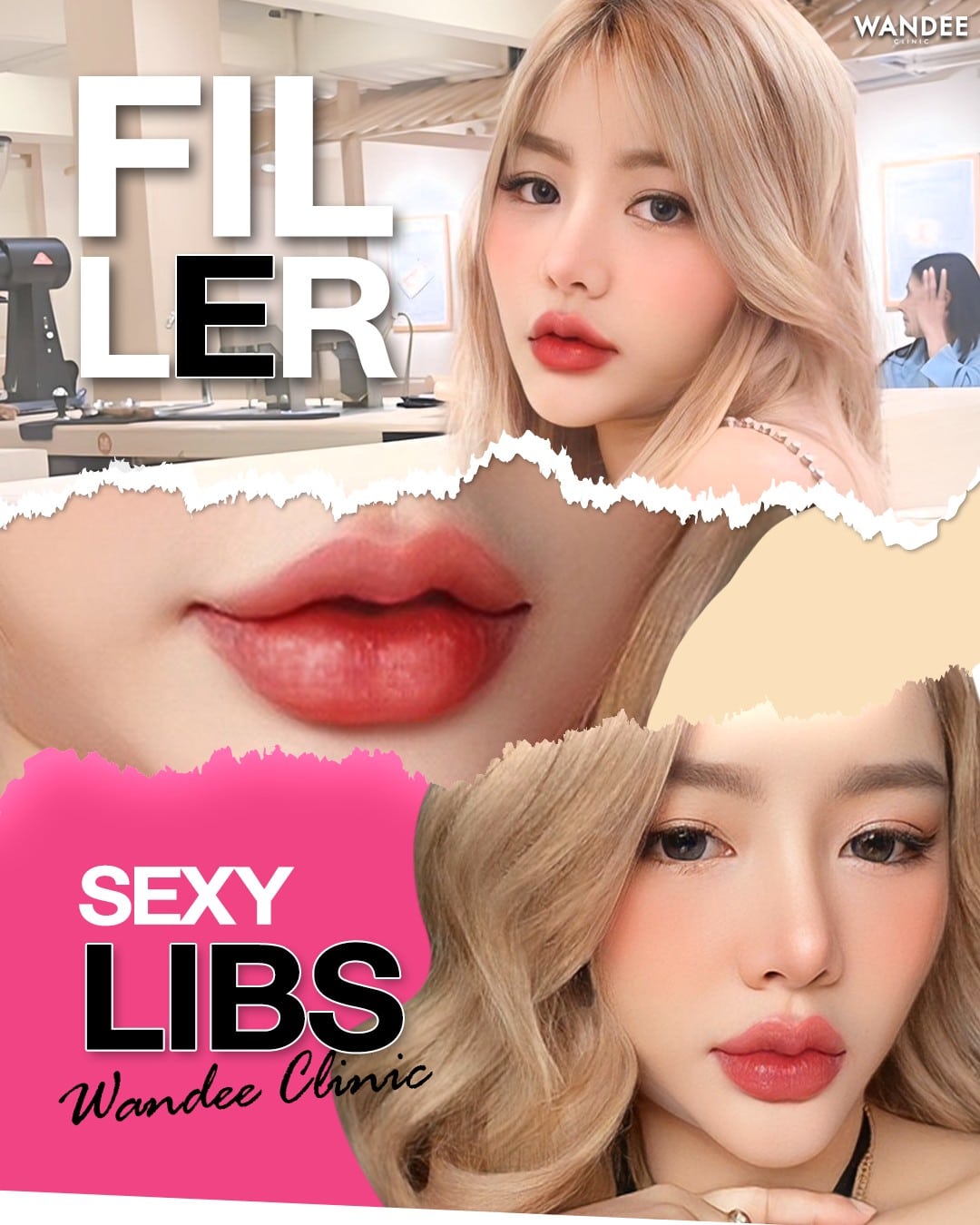 ฟิลเลอร์ปากสายเกา