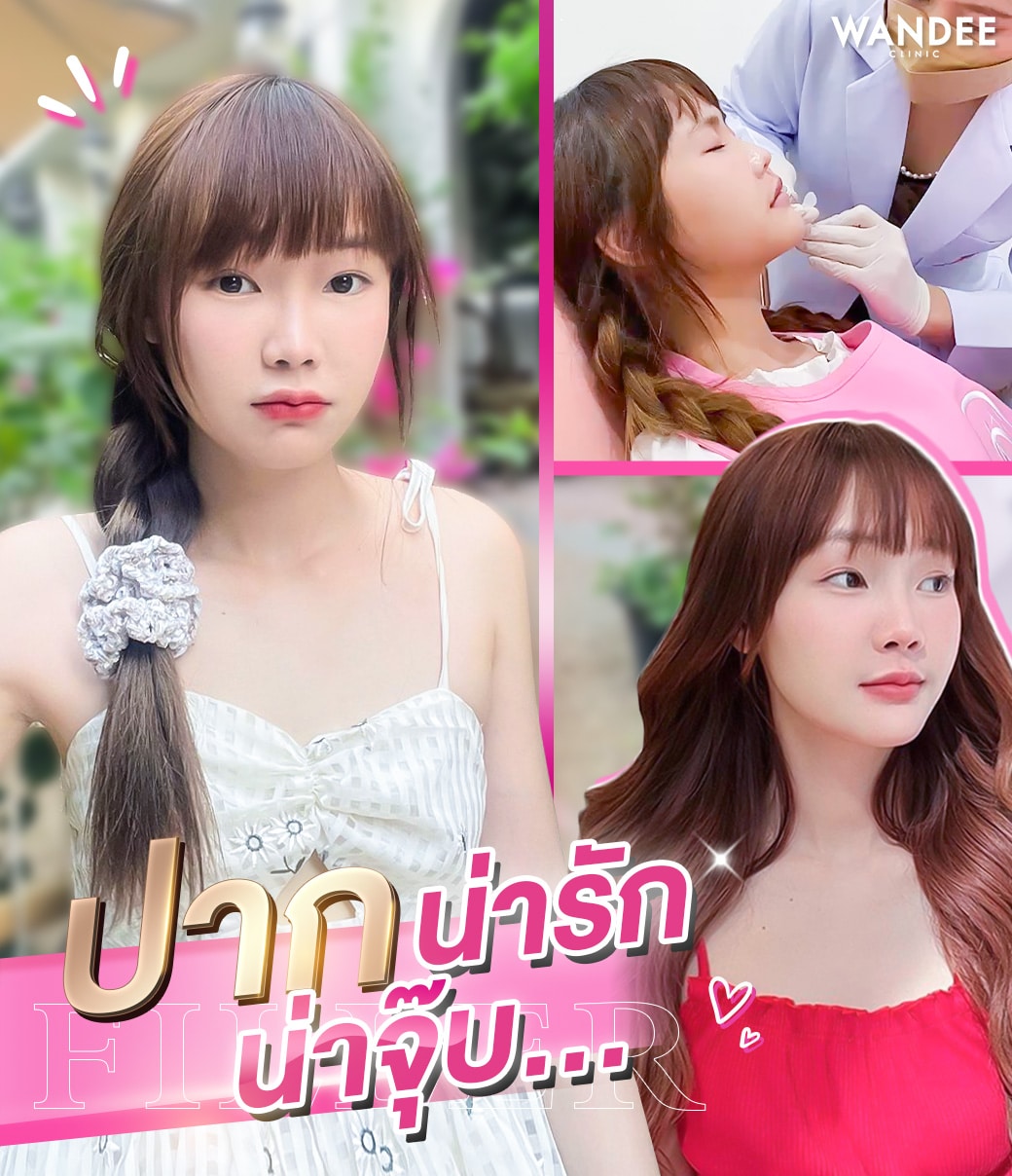 หมดปัญหาปากบางไม่ได้รูป