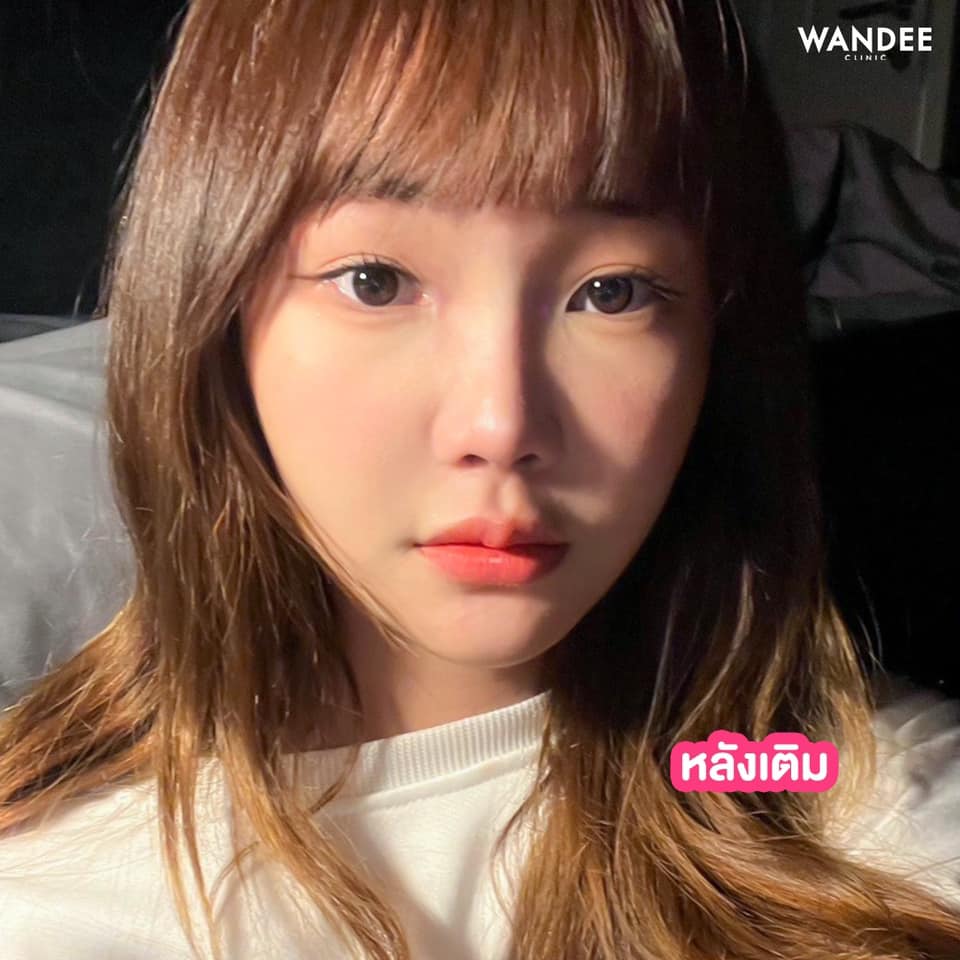 หมดปัญหาปากบางไม่ได้รูป