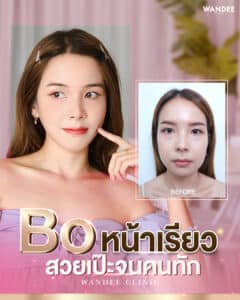 𝗕𝗢 ลดกรามกรอบหน้า