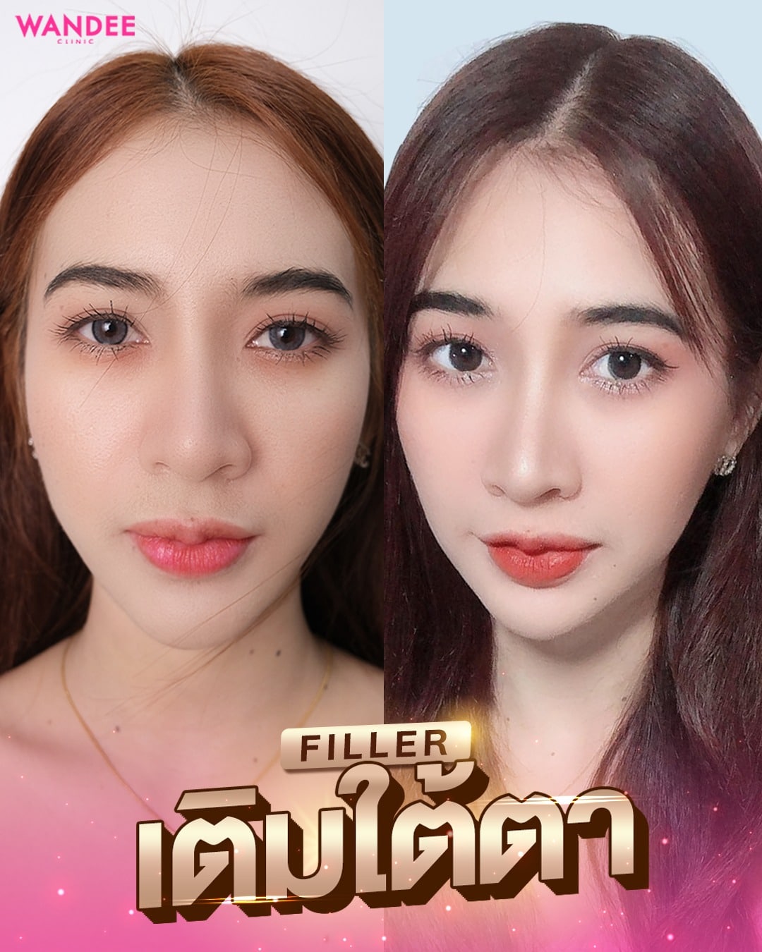 𝗣𝗿𝗼𝗴𝗿𝗮𝗺 𝗙𝗶𝗹𝗹𝗲𝗿 ใต้ตา