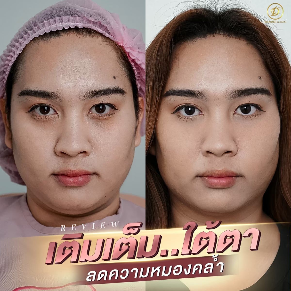 𝗣𝗿𝗼𝗴𝗿𝗮𝗺 𝗙𝗶𝗹𝗹𝗲𝗿 ใต้ตา