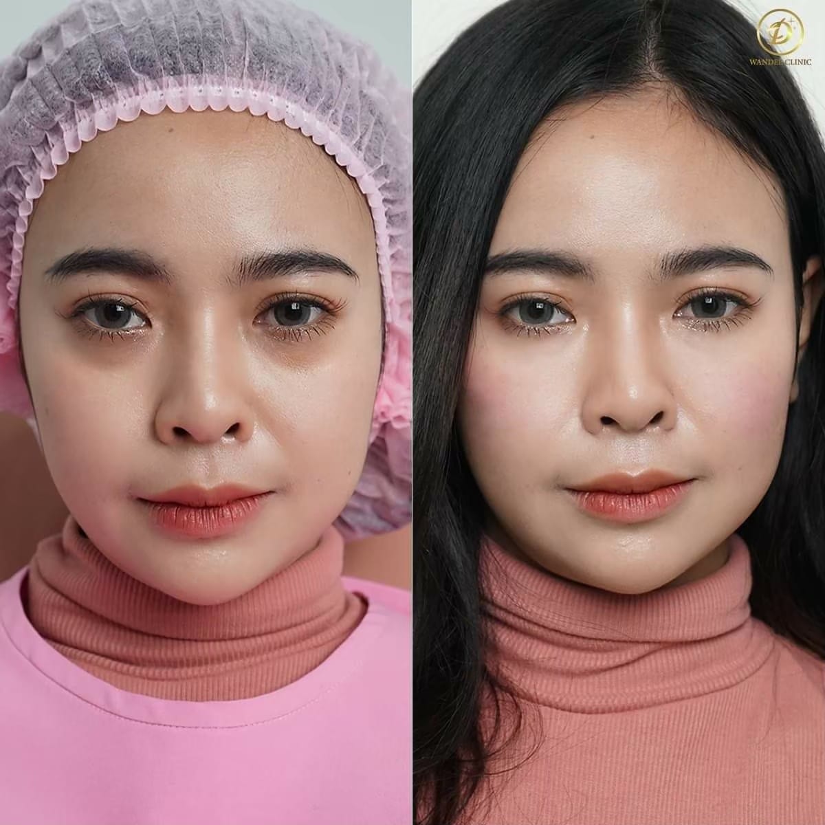 𝗣𝗿𝗼𝗴𝗿𝗮𝗺 𝗙𝗶𝗹𝗹𝗲𝗿 ใต้ตา