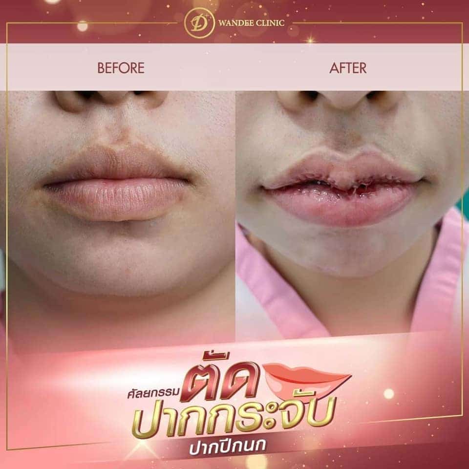 ศัลยกรรมปากปรับรูปปาก