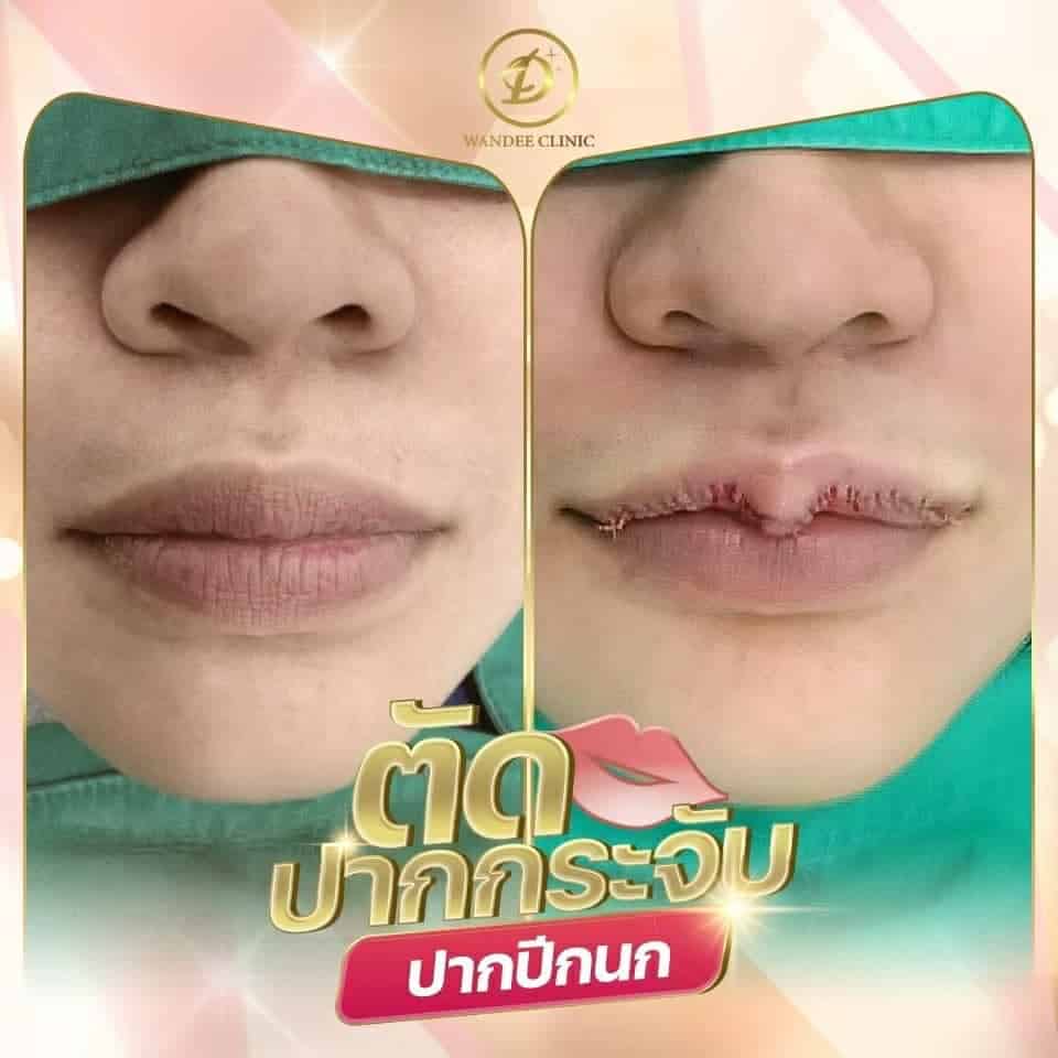 ศัลยกรรมปากปรับรูปปาก