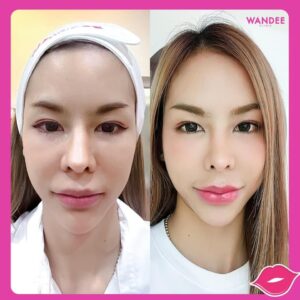 รีวิวฟิลเลอร์