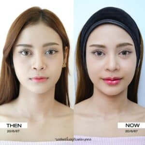 รีวิวฟิลเลอร์