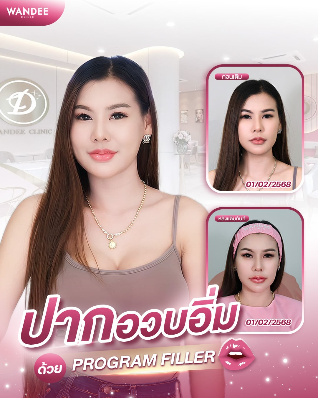 ฟิลเลอร์ปาก