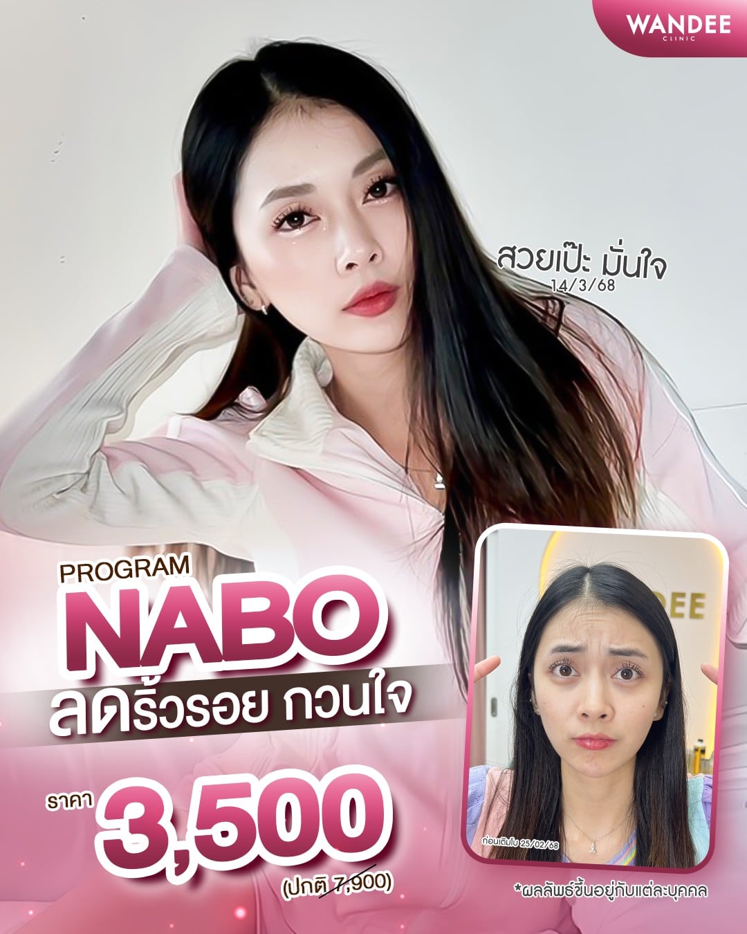 𝗣𝗿𝗼𝗴𝗿𝗮𝗺 𝗡𝗔𝗕𝗢 ลดริ้วรอยทั่วหน้า