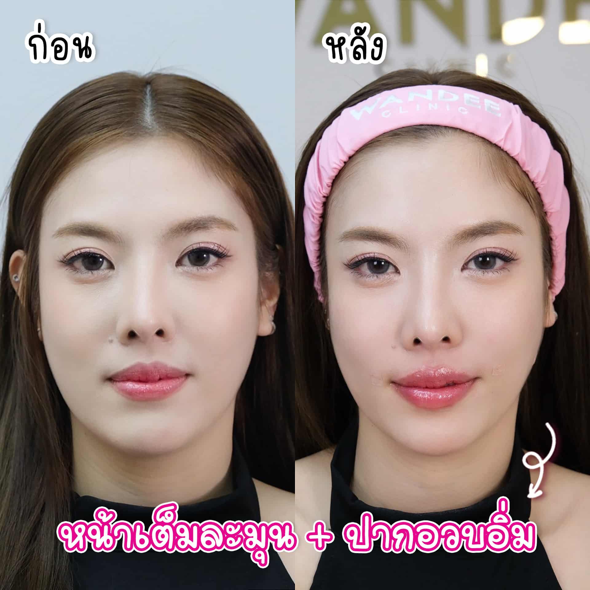 ฟิลเลอร์ปรับรูปหน้า มุ้งมิ้ง