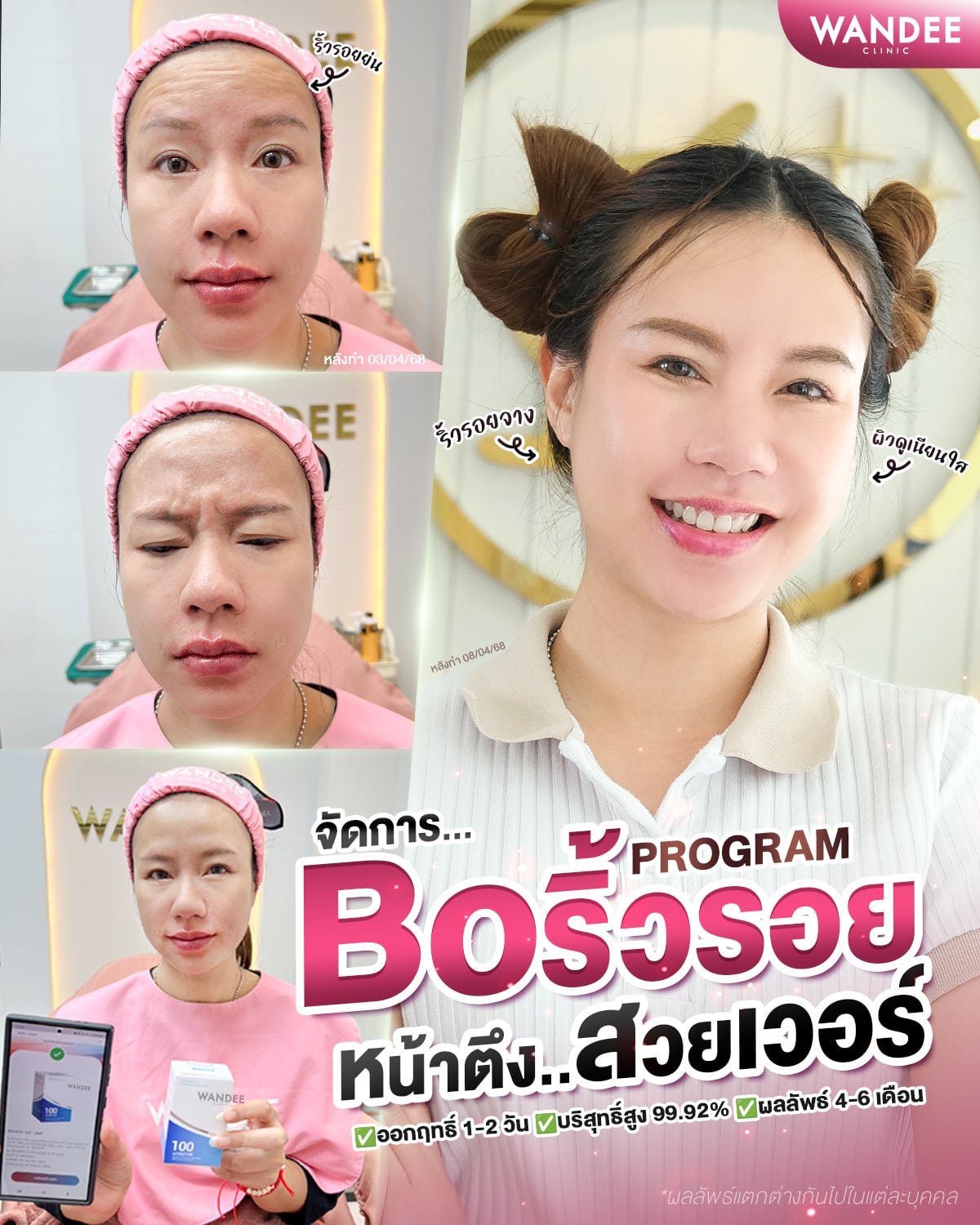จัดการริ้วรอย