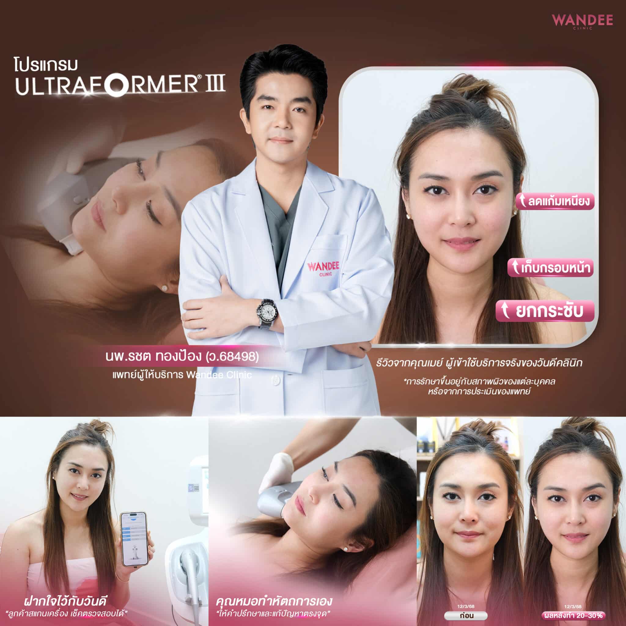 ultraformer เมย์
