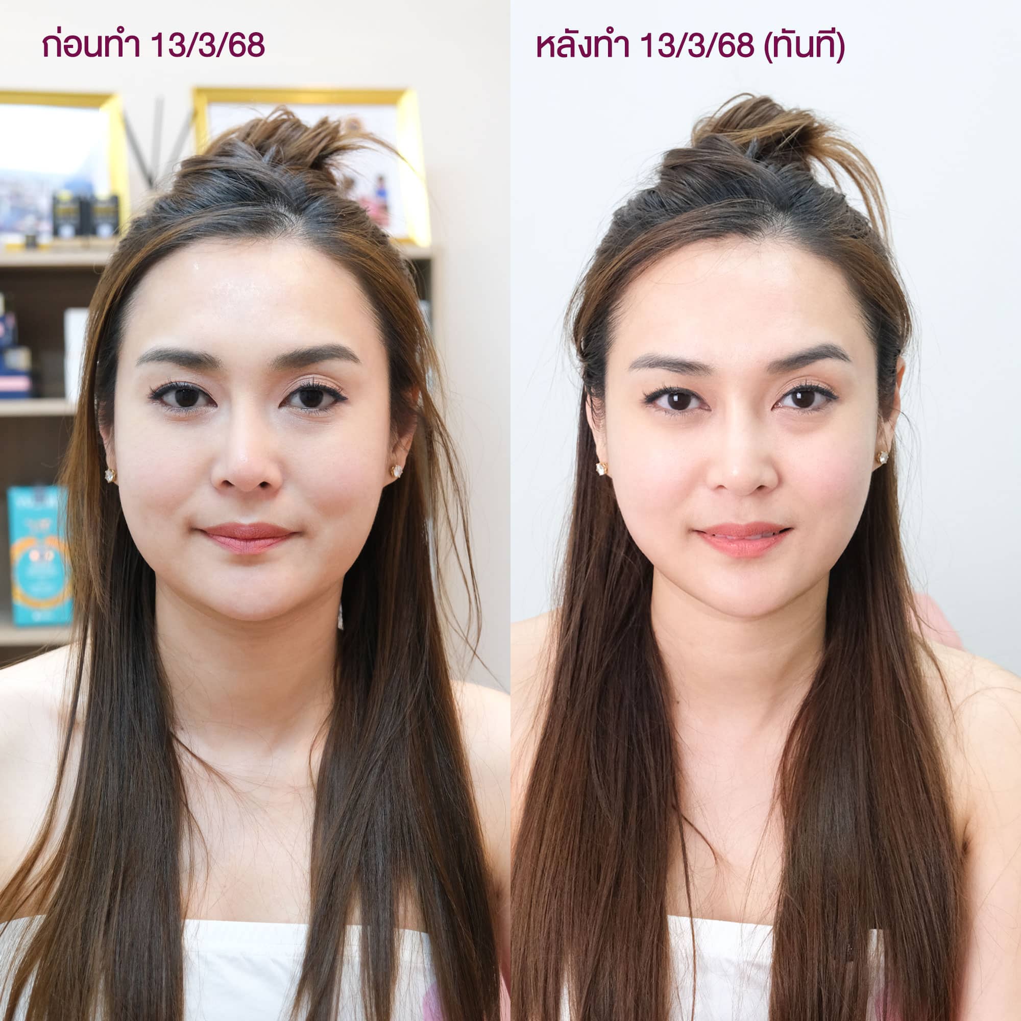 ultraformer เมย์
