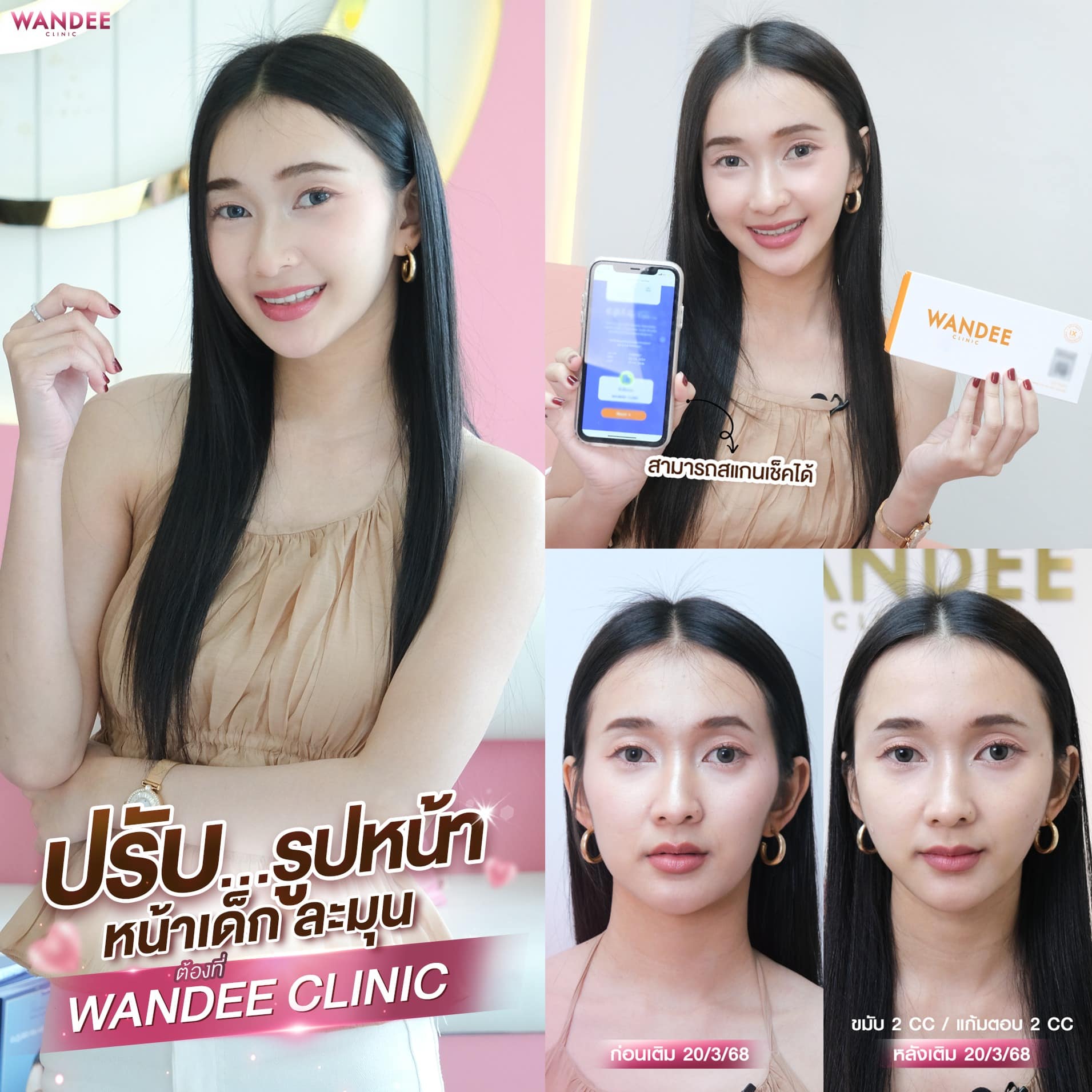 Filler ขมับ+แก้มตอบ แมงปอไว้ใจวันดีคลินิก