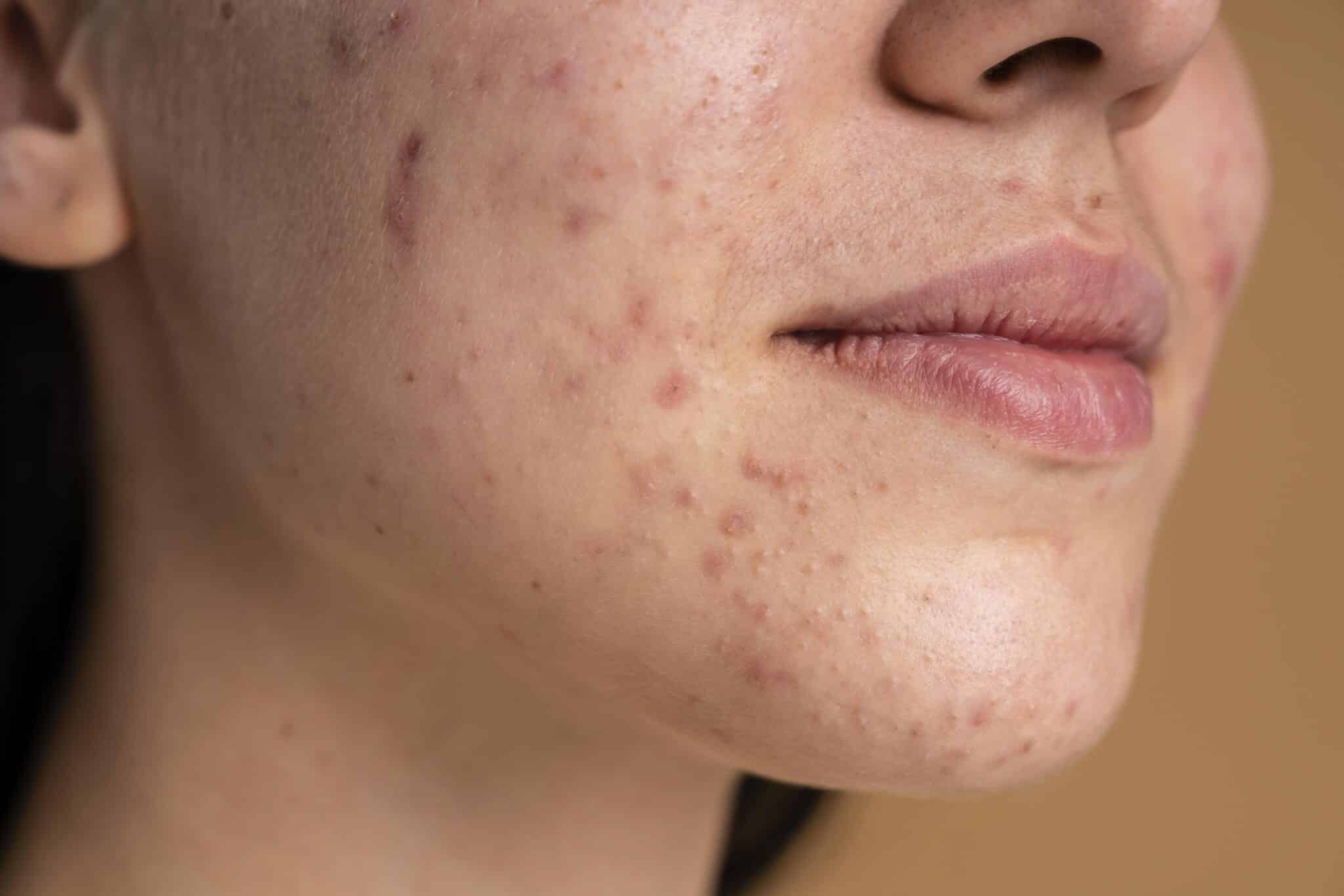 สิวแบบไหนเหมาะกับฉีดสิว acne injections