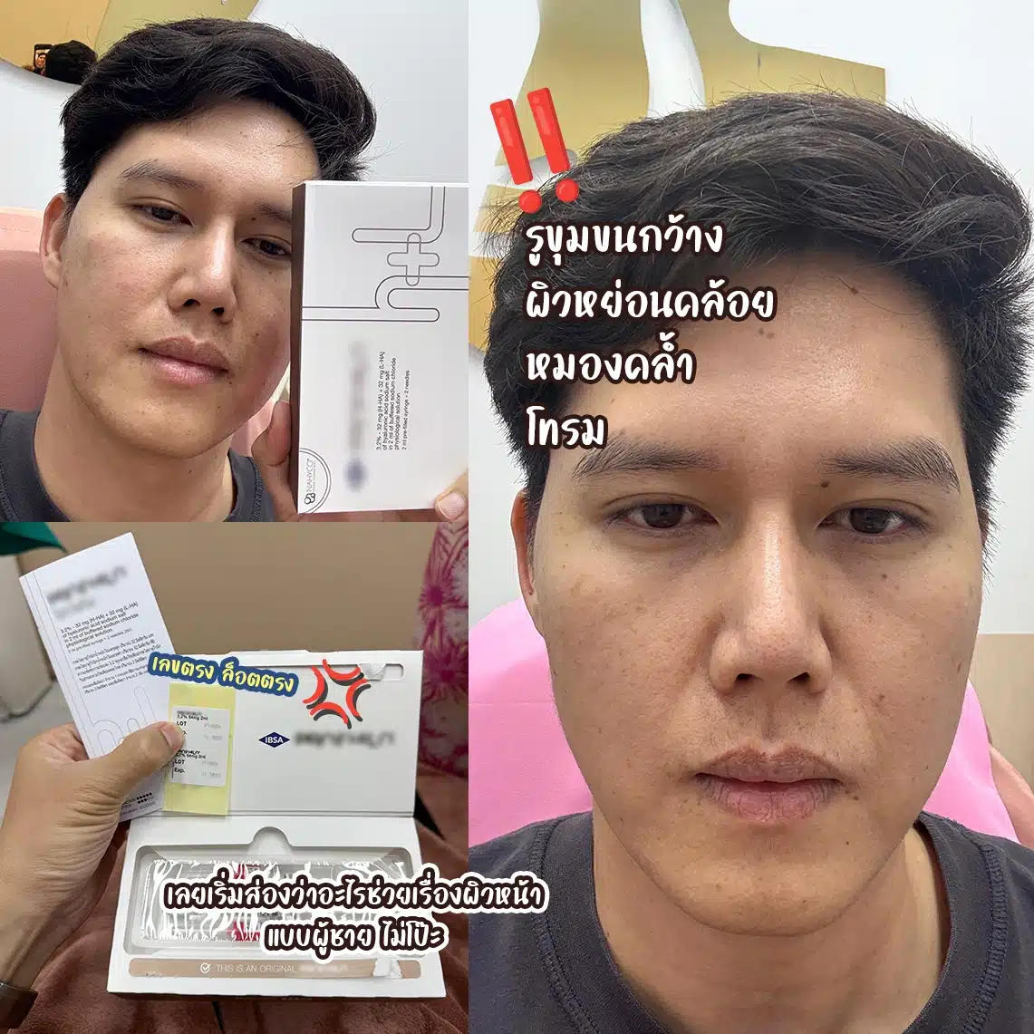 รีวิว Profhilo ที่ Wandee Clinic